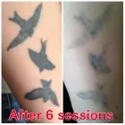 Business 4 image THE MISSING INK: LASER TATTOO REMOVAL Tattoo Removal Service in Hazel Grove Gr