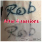 Business 5 image THE MISSING INK: LASER TATTOO REMOVAL Tattoo Removal Service in Hazel Grove Gr