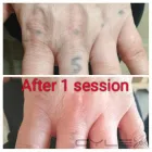 Business 8 image THE MISSING INK: LASER TATTOO REMOVAL Tattoo Removal Service in Hazel Grove Gr