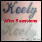 Business 9 image THE MISSING INK: LASER TATTOO REMOVAL Tattoo Removal Service in Hazel Grove Gr