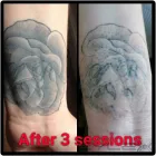 Business 10 image THE MISSING INK: LASER TATTOO REMOVAL Tattoo Removal Service in Hazel Grove Gr